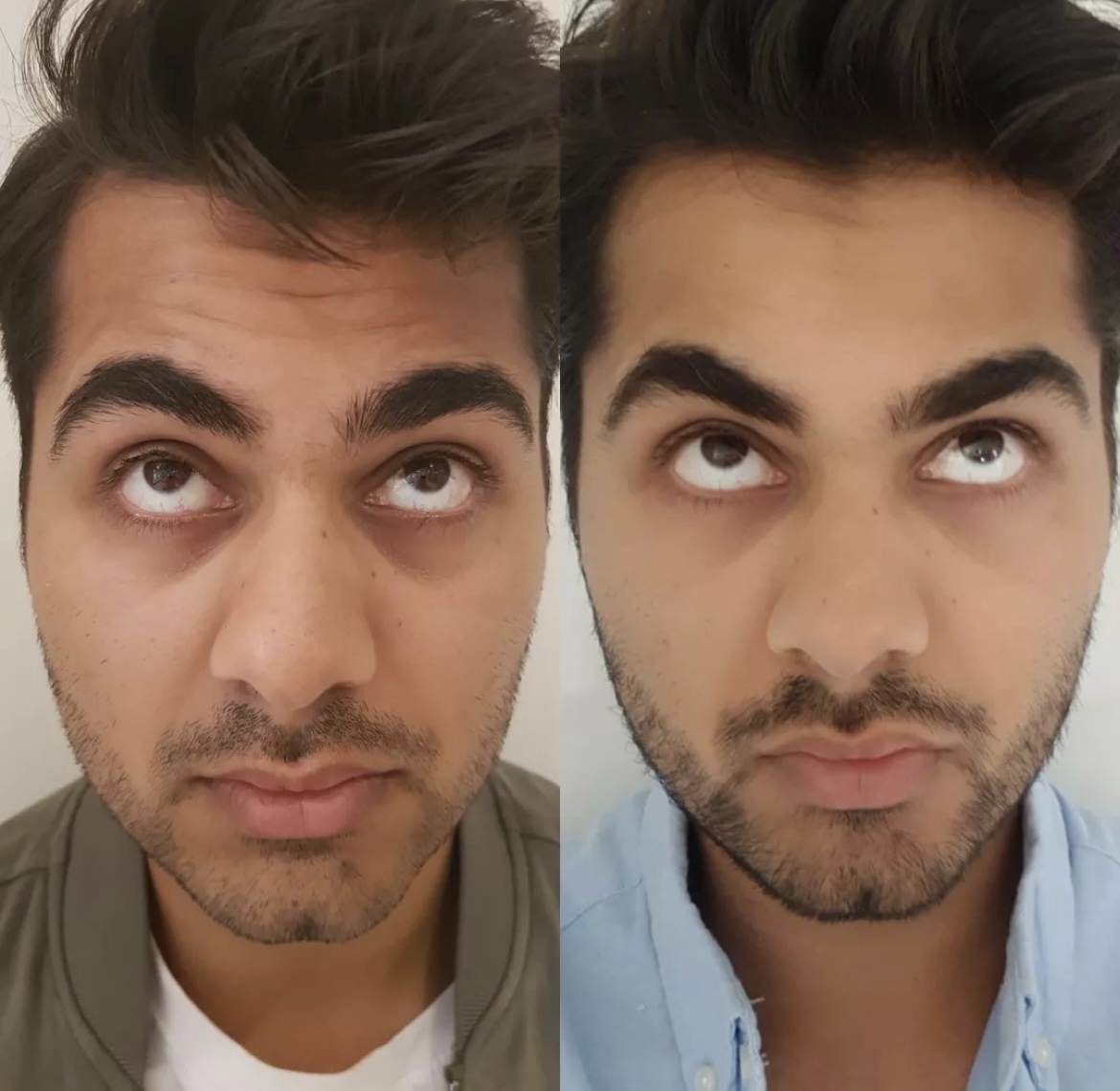 Tear trough treatment