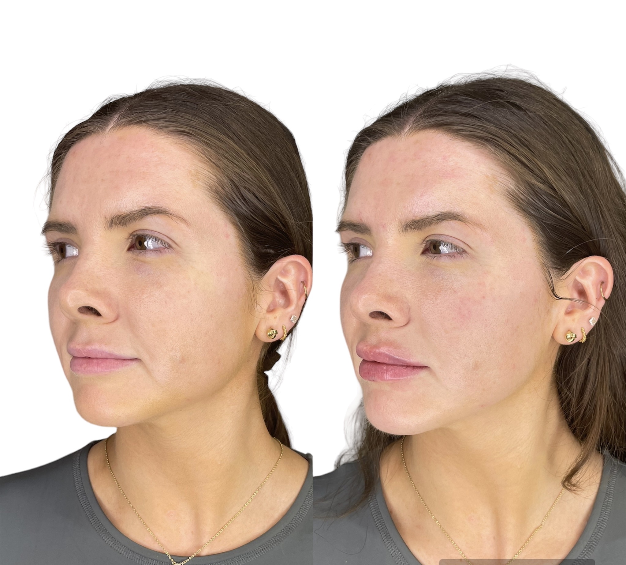 Full Face Treatment Roda Clinics in Chiswick and Iver