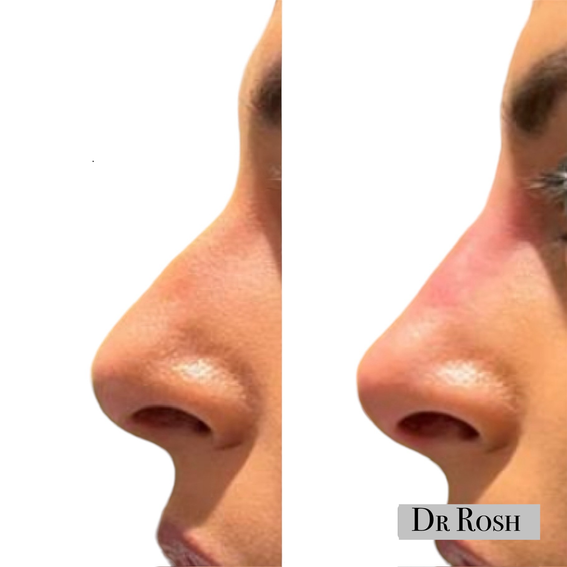 Nose Filler