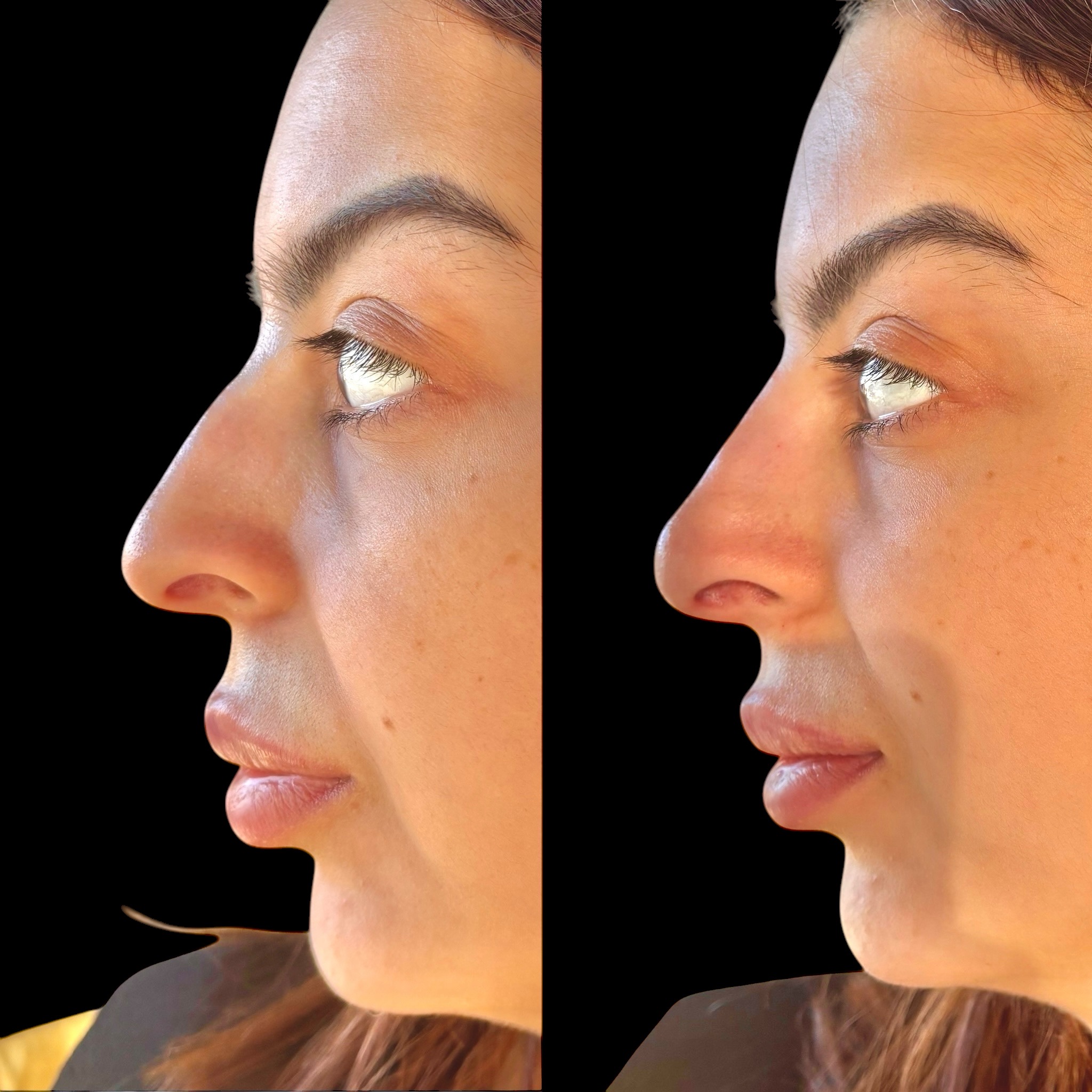 Nose Filler