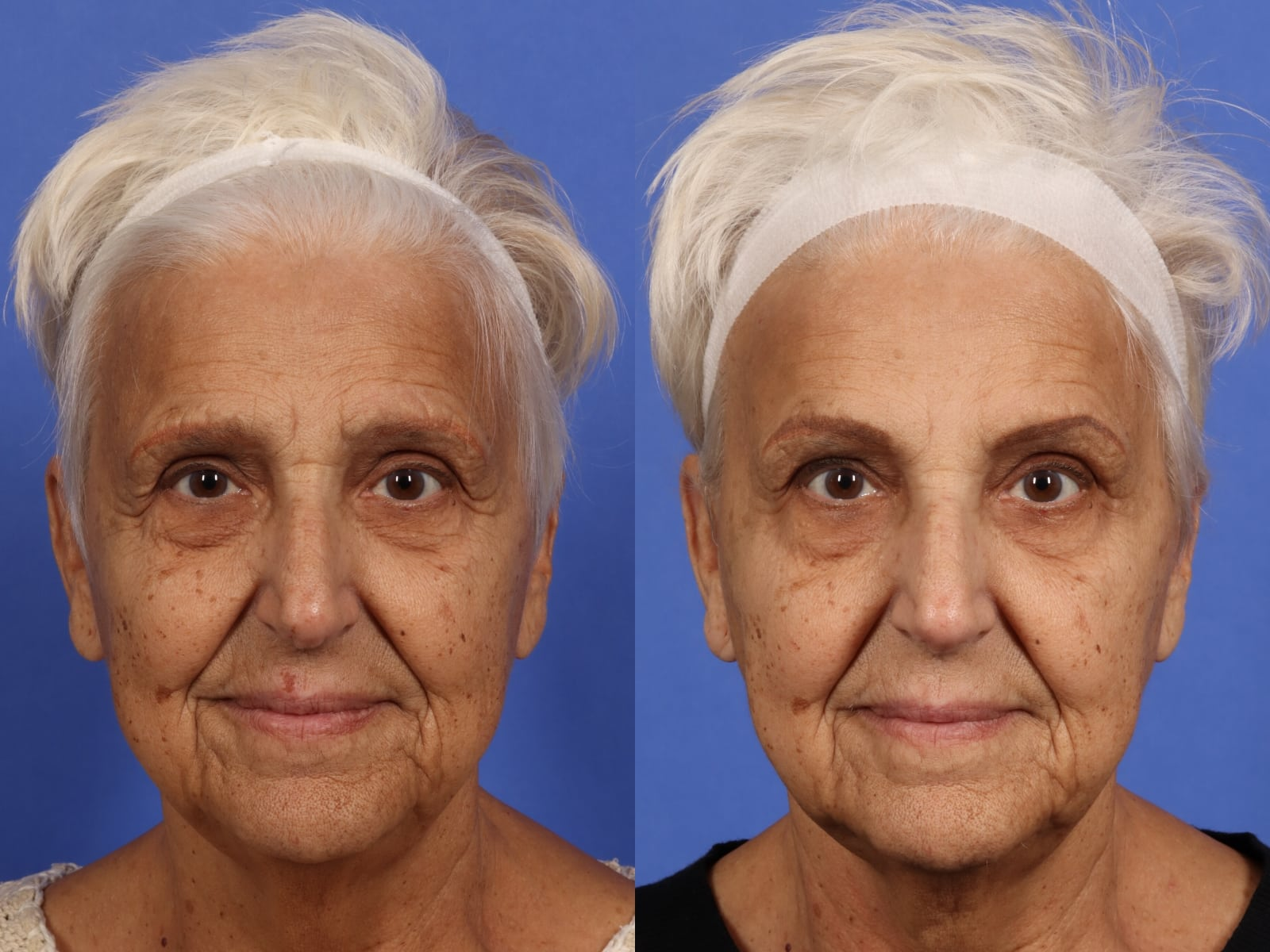 1st image botox B&A