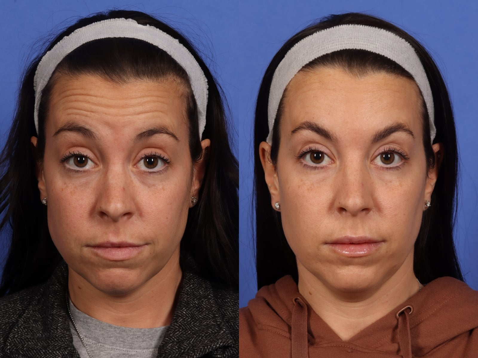 3rd image botox B&A