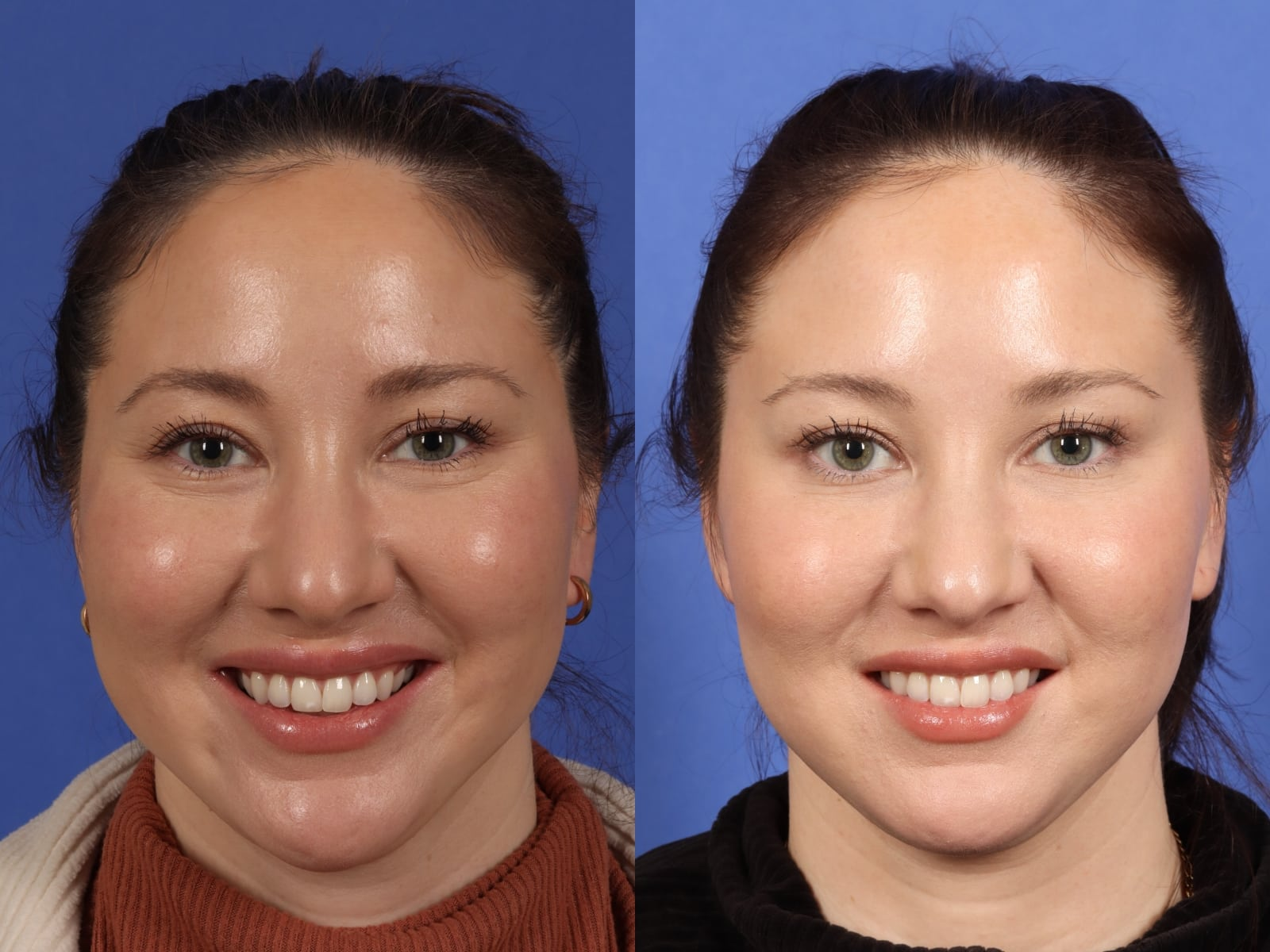 4th image botox B&A