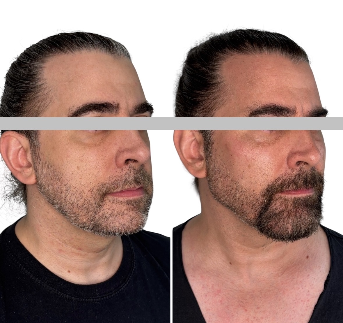 Jaw and Chin Filler