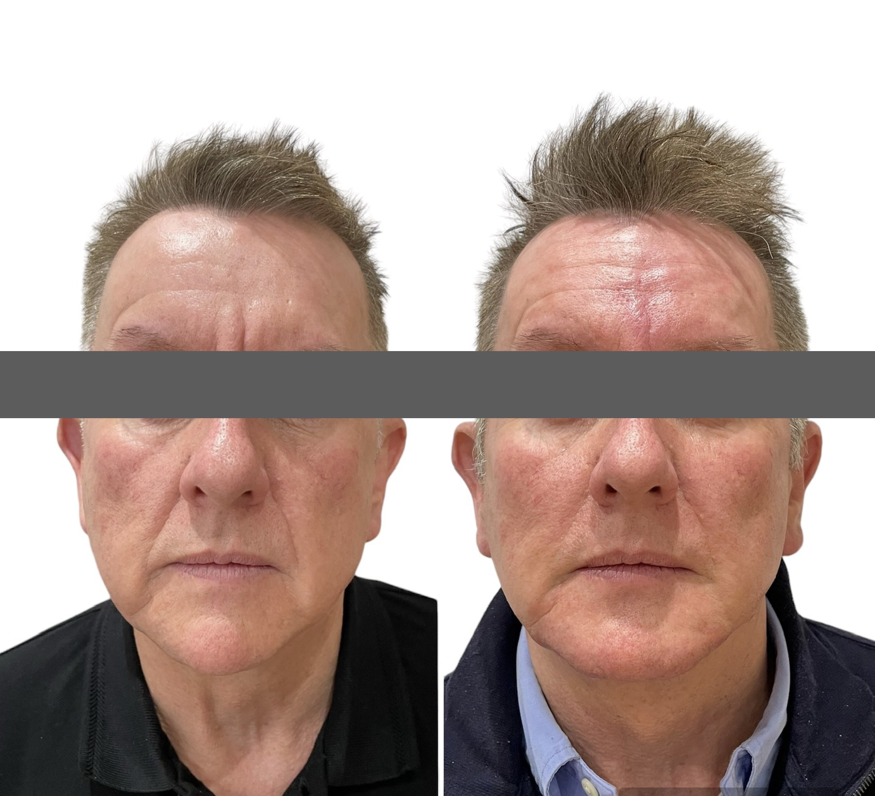 Structural Rejuvenation