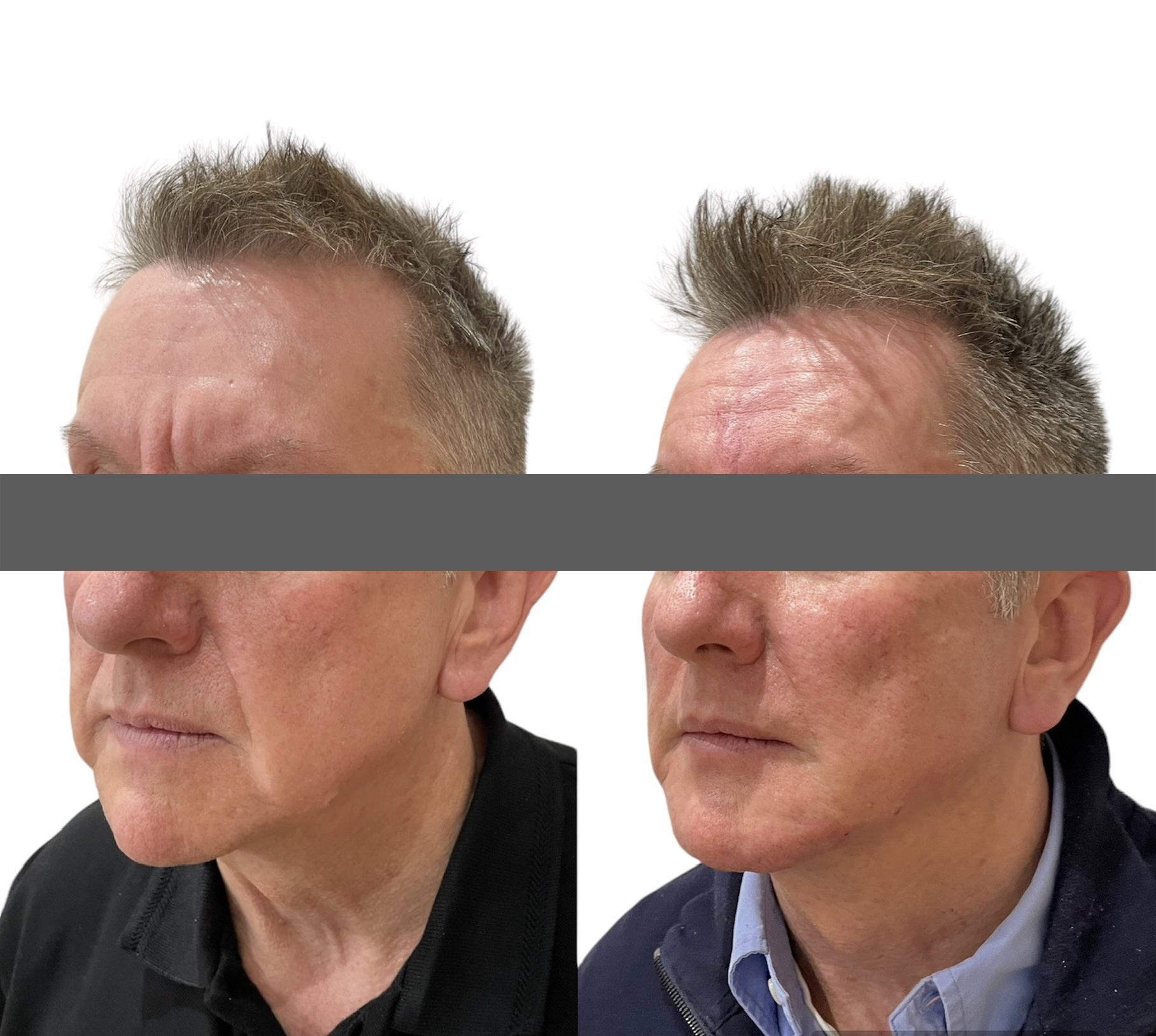 Structural Rejuvenation