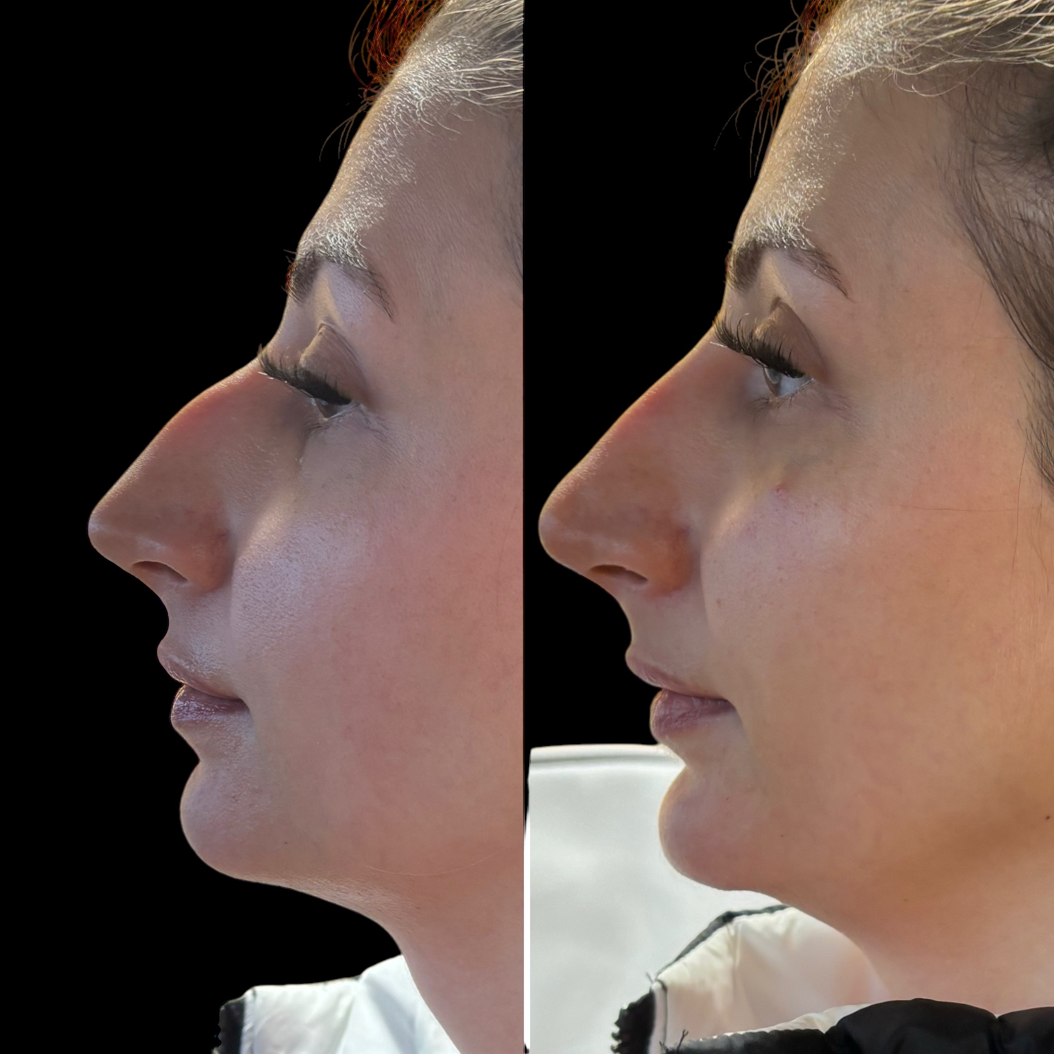 Nose Filler