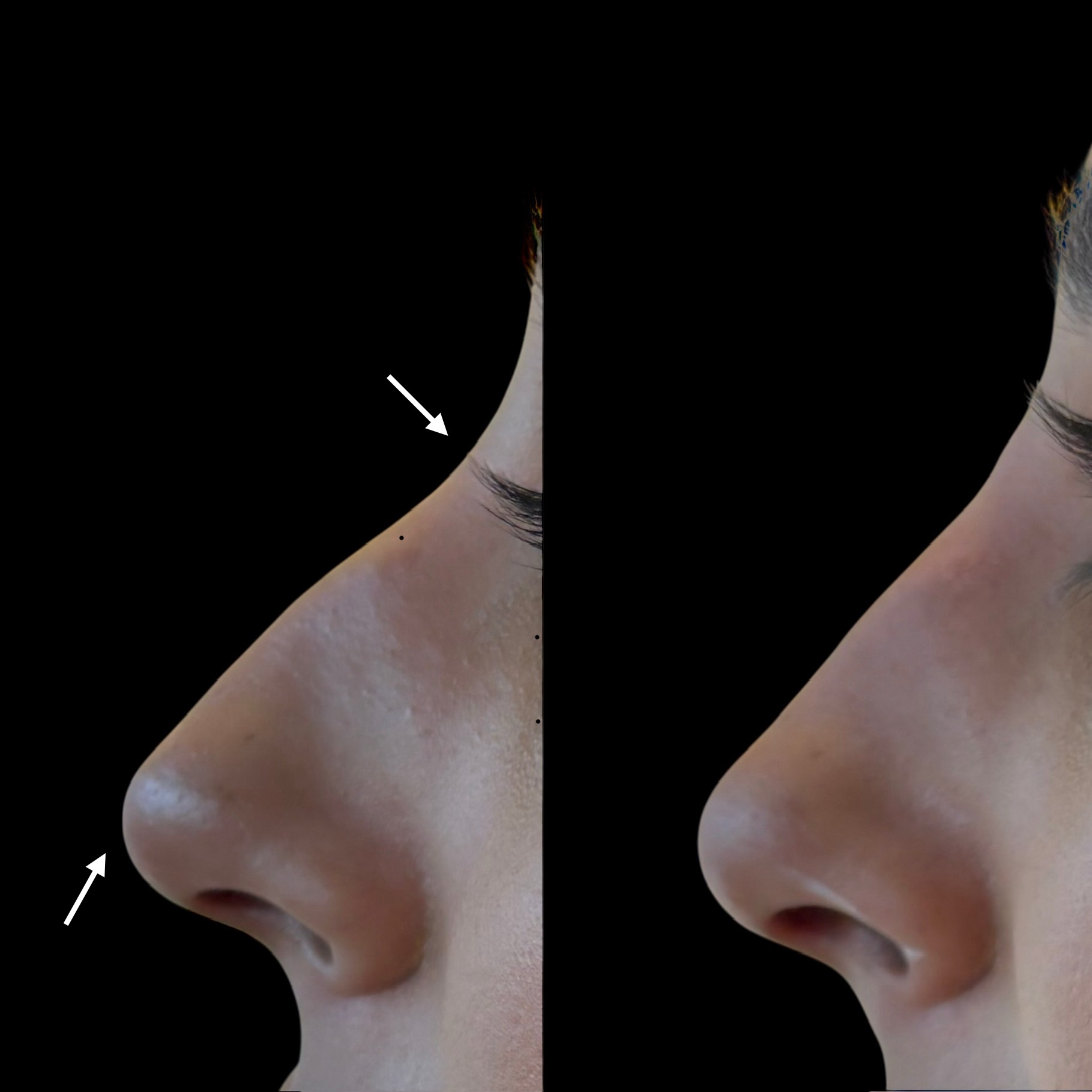 Nose Filler