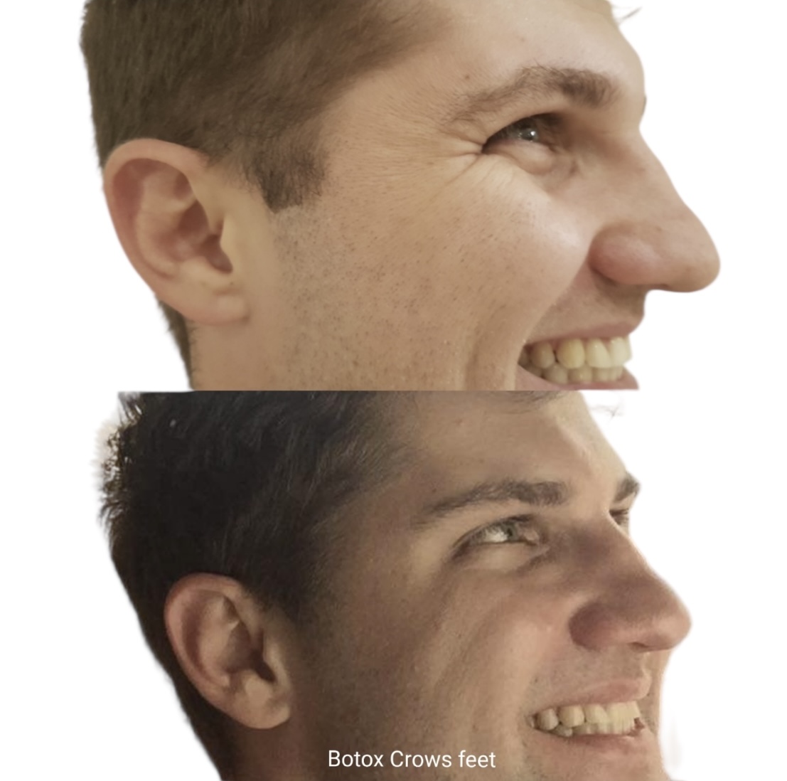 Botox crows feet